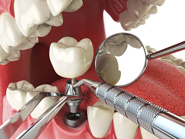 Best Chipped Tooth Repair Near Me  in New Boston, TX